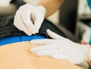 Dry Needling used for Sciatica