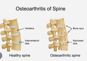 Osteoarthritis of spine 