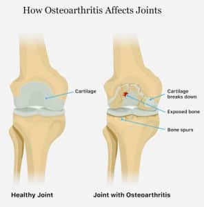 the effect of osteoarthritis in the knee