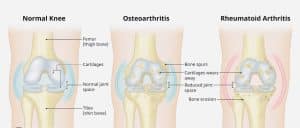 The two types of Osteoarthritis arthritis vs the norm