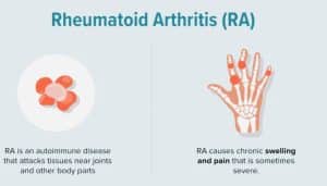 Rheumatoid Arithritis