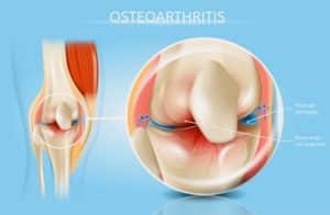 Osteoarthritis in the knee joint 