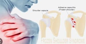 The inflammatory changes to the capsule of the shoulder joint 