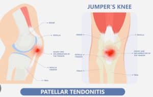 Patellar Tendon also known as Jumper's knee