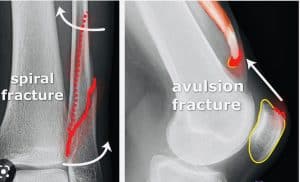 Difference between Spiral Fracture and Avulsion fracture 