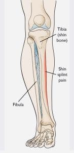 How Shin splint pain affects the leg