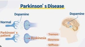 Dopamine levels are reduced in Parkinson's