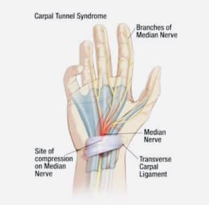 What is Carpal tunnel Syndrome