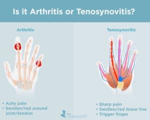 The difference between Arthritis and Trigger Finger also known as Stenosing Tenosynovitis 