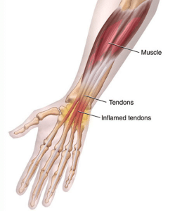 tendonitis of the wrist
