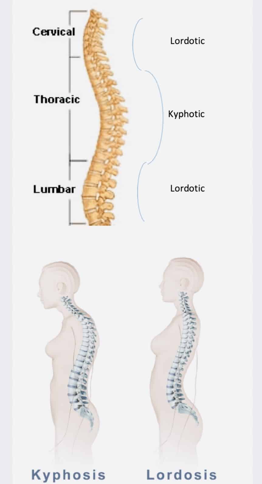Understanding the spinal curvature conditions of lordosis (inward curve) and kyphosis (outward curve) and their impact on spine health.