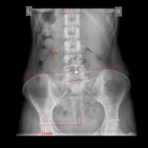 Pre Corrective Treatment xray showing clinically significant left hip discrepancy, without an insole. This affects the pelvis position and spine alignment.