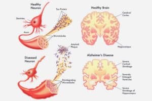 Compare a healthy brain with an Alzheimer's brain to understand how Alzheimer's impacts balance. Emphasizes the importance of early detection and management for brain health and balance.