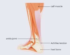 Achilles tendinopathy description 