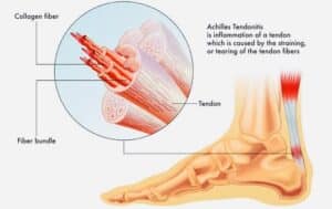 Achilles tendinopathy when injury takes place 
