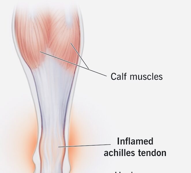 Achilles Tendonitis