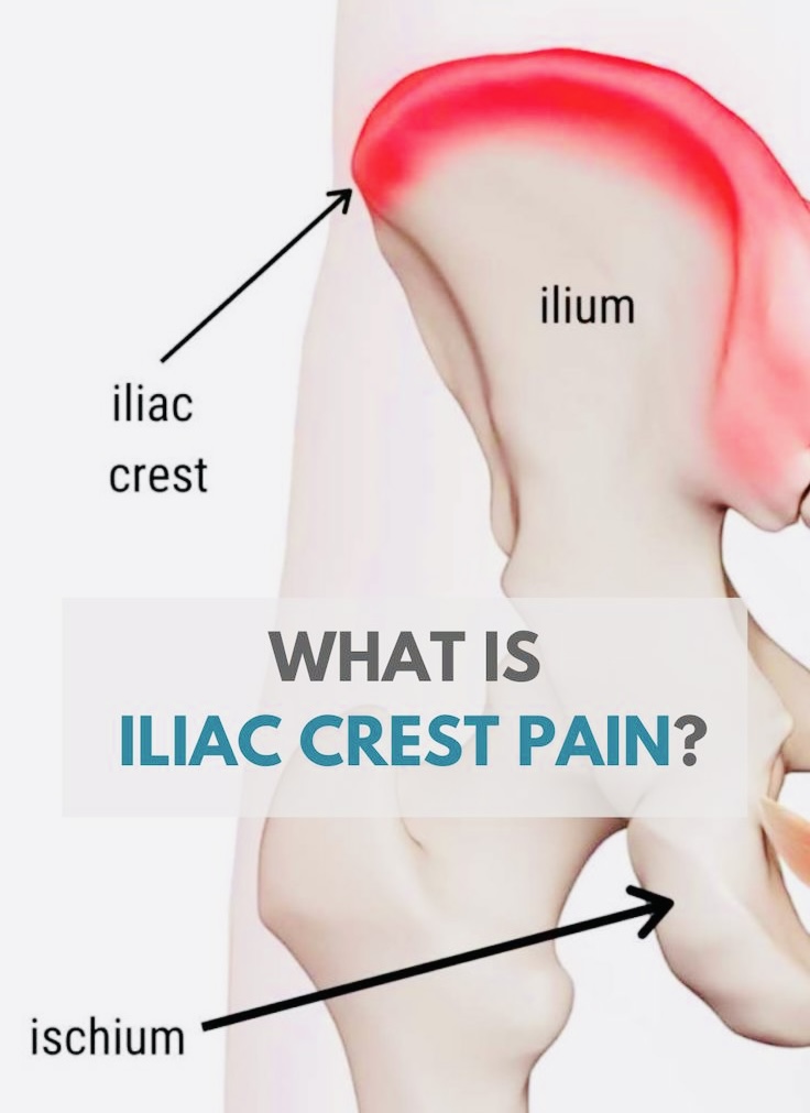 What is iliac crest pain