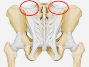 Iliolumbar Ligament Irritation