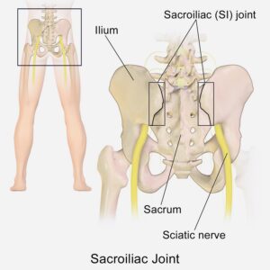 Sacroiliac Joint Irritation