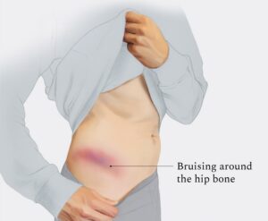 A fall, collision or sporting impact can bruise the tissues around the iliac crest.