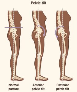 If your lumbar spine becomes stiff, your pelvis may adapt its movement.